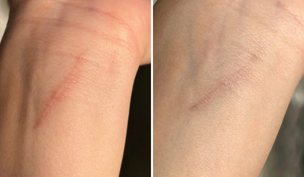 Luviva - Fortschrittliches Silikonband zur Narbenbehandlung & Falten