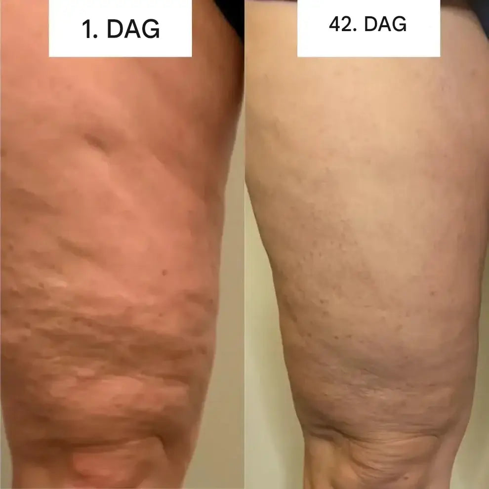 GlowCup - Cellulite-Entferner und Hautstraffung mit Rotlicht und Schröpfkopftherapie