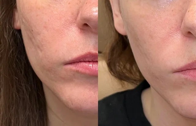 Luviva - Fortschrittliches Silikonband zur Narbenbehandlung & Falten