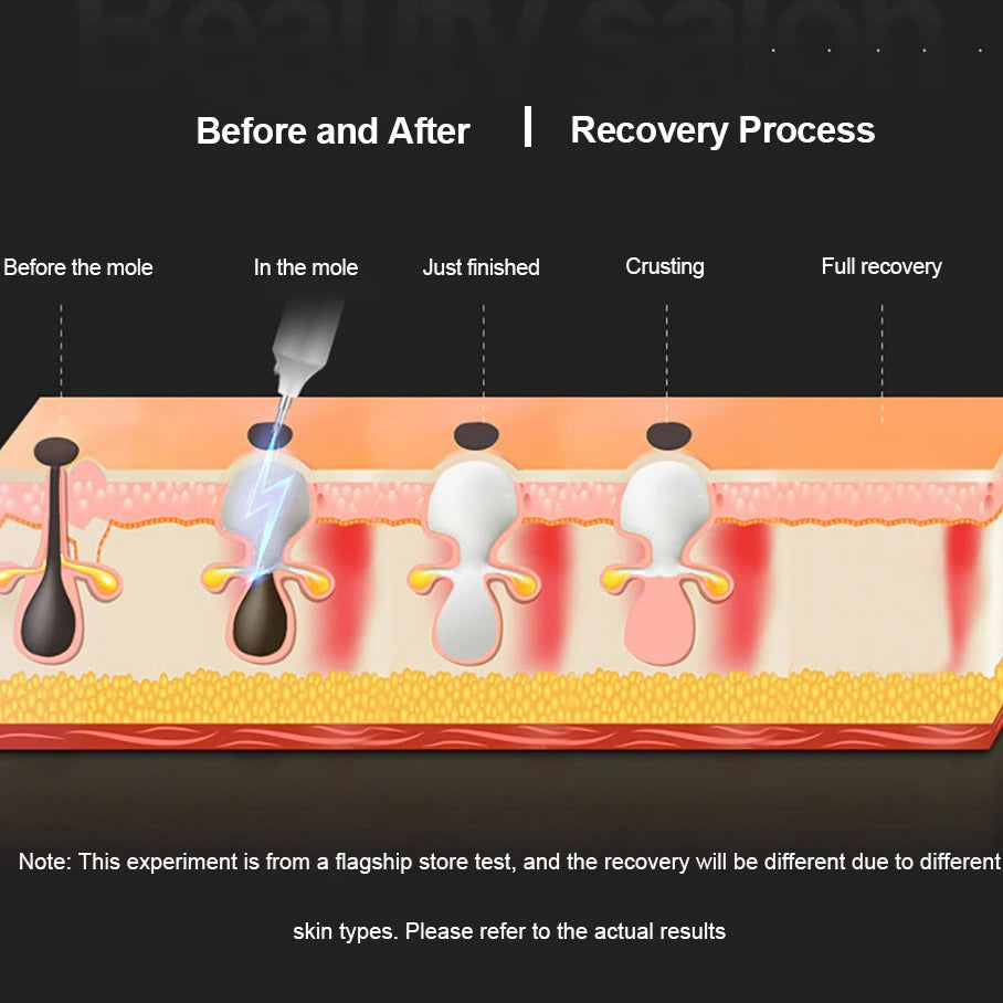Plasma-Stift zur Entfernung von Hautmarkierungen
